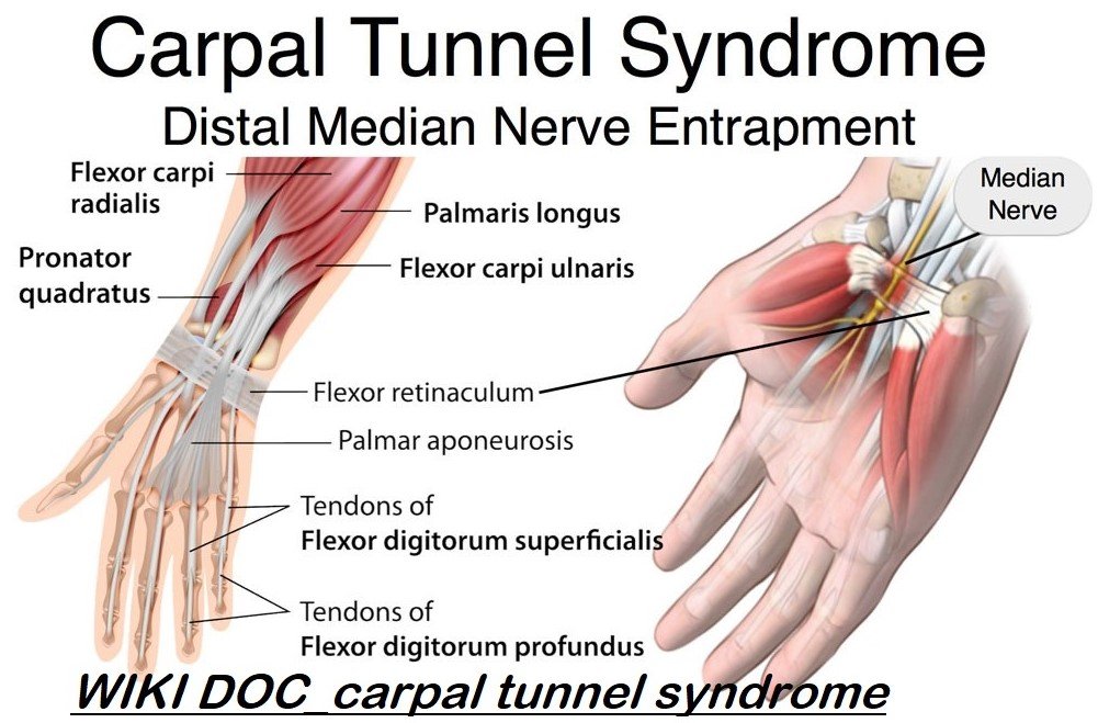 Carpal tunnel syndrome