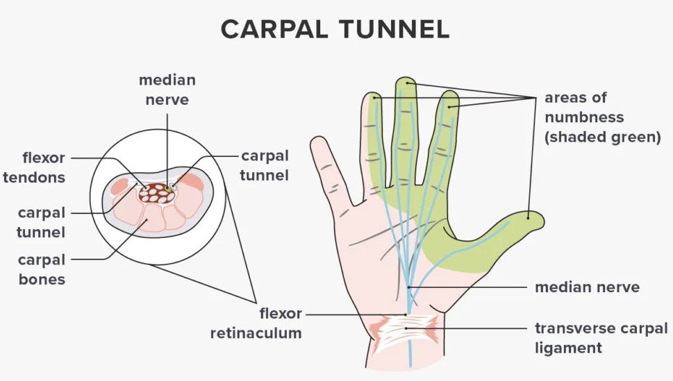 Conditions that are often misdiagnosed as carpal tunnel syndrome