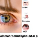 What is commonly misdiagnosed as Pink eye - Conjunctivitis